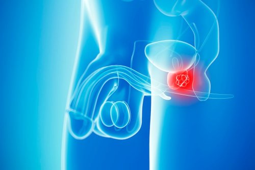 Mögliche Anzeichen von Prostatakrebs, Diagnose und Behandlung