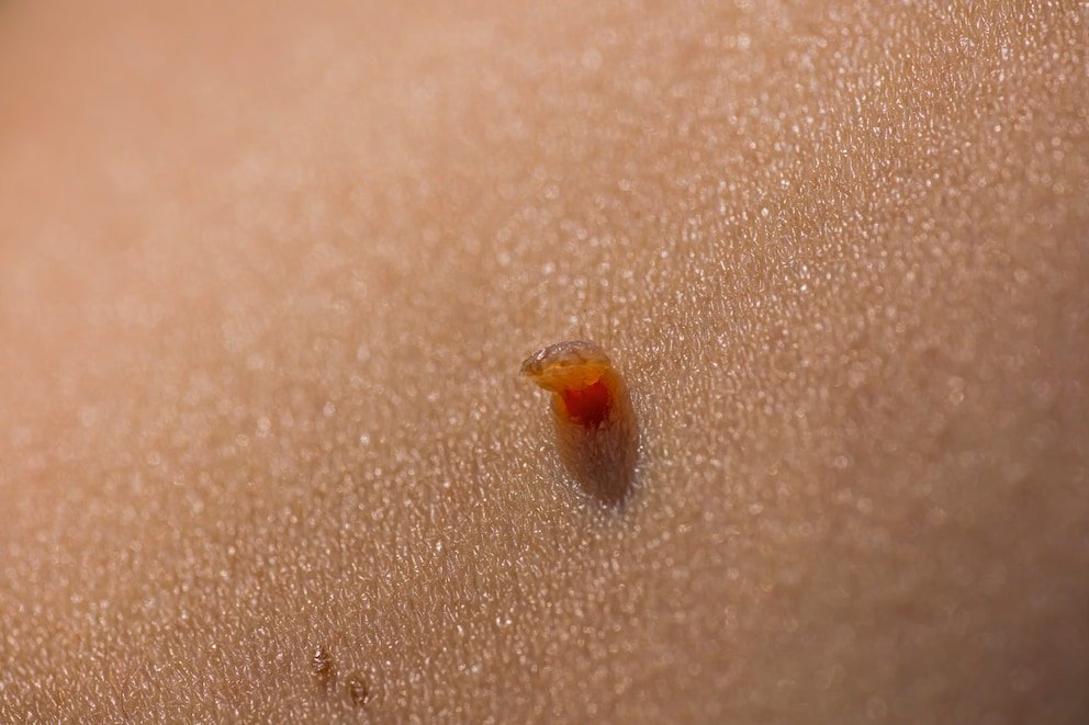Fibrome – was hilft bei Stielwarzen auf der Haut?