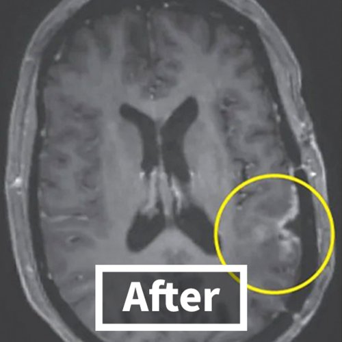 Glioblastoma Patient Sees Tumor Almost Disappear In Days Thanks To New Breakthrough