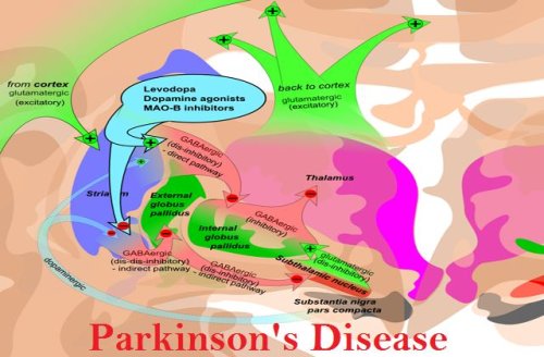Parkinson's Disease -Symptoms, Causes and Treatment | How to Prevent Parkinson's Disease