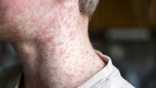 Measles cases are rising in the U.S. Do adults need a vaccine booster?