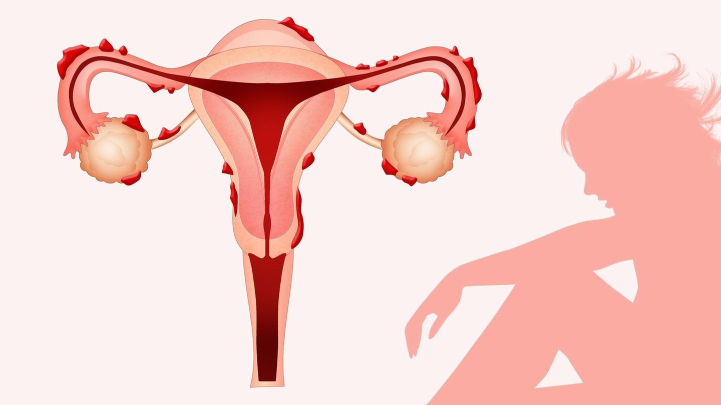 Warum Endometriose in den Wechseljahren zurückkehrt