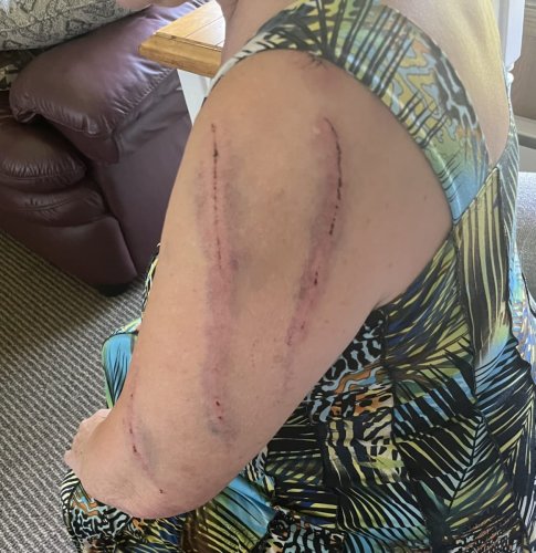 Photo shows wounds suffered by Minneapolis woman in rural Minnesota bear attack