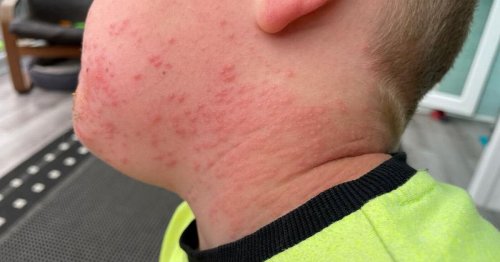 Mum's warning as son, 4, breaks out in severe rash all over his body after touching caterpillar