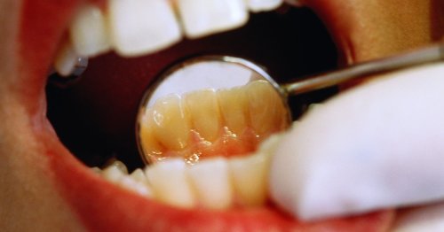 UK in grip of dental crisis - Have your say