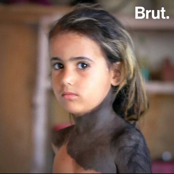 Cette petite fille irakienne souffre d'une rare maladie de peau | Brut.