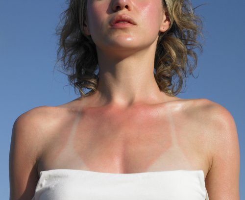 Fünf Möglichkeiten zur Behandlung von Sonnenbrand – und wie ihr eure Haut am besten schützt