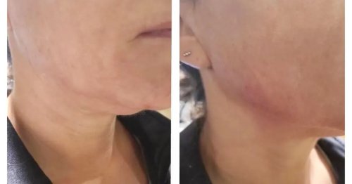 Meet Volux — The New FDA-Approved Filler That Sculpts Chiseled Jawlines