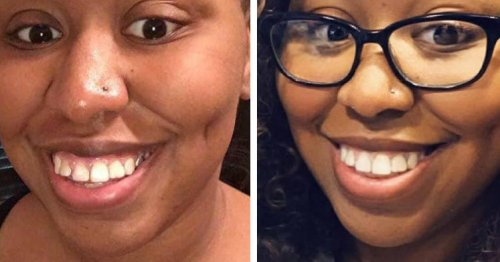 This Company Is Trying To Disrupt The Braces Industry And Dentists Are Fighting Back
