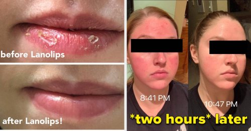 31 Skincare Products With Before & After Photos So Dramatic, We Made Them Click To Reveal
