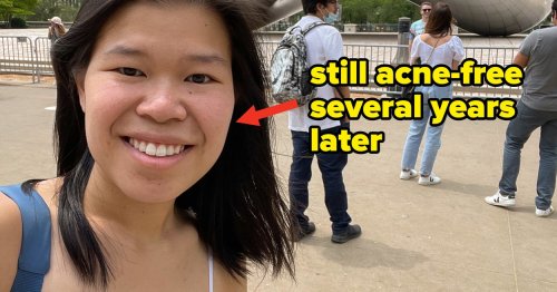 Accutane Cleared Up My Cystic Acne When Nothing Else Worked — But The Experience Had Its Ups And Downs