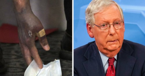 Mitch McConnell's Hand Is Discolored But He Swears Nothing Is Wrong