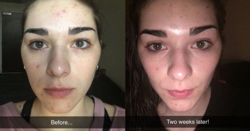 31 Things That'll Make Acne Wish It Had Never Been Born