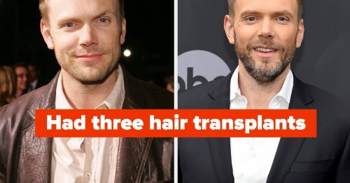 Male Celebs Discuss Hair Transplants and Wigs