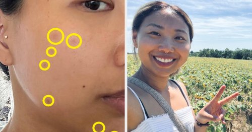 After My Acne Flared Up On Vacation, A French Pharmacist Helped Clear Up My Skin With These Two Products