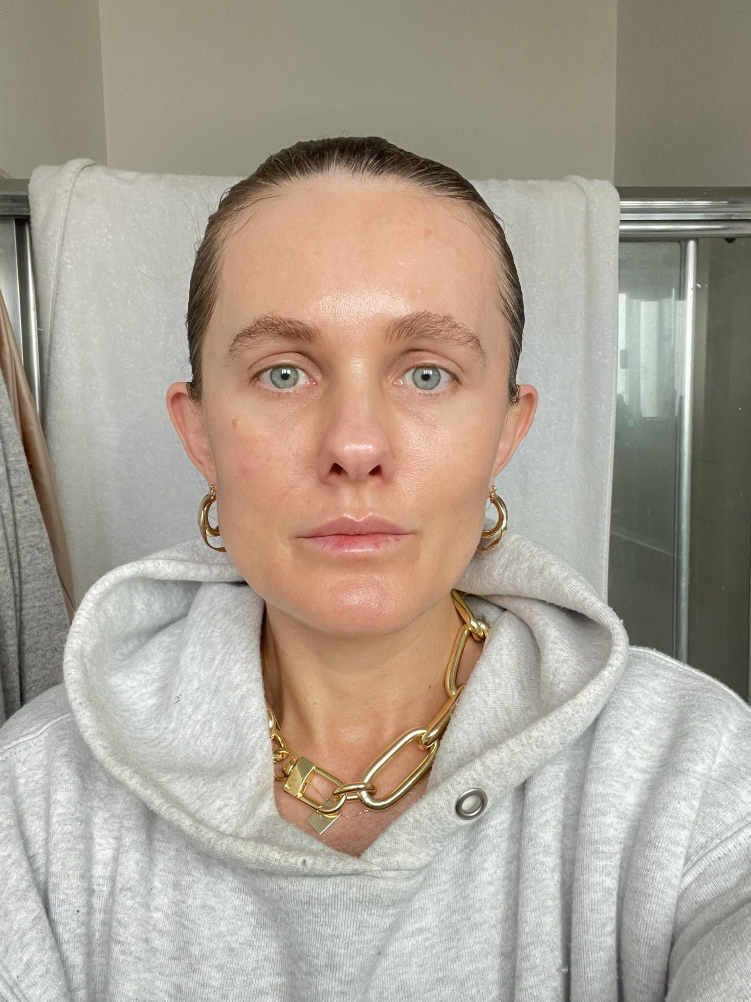 I Had Microneedling With PRP and It Was a Total Gamechanger—Here's What You Need to Know