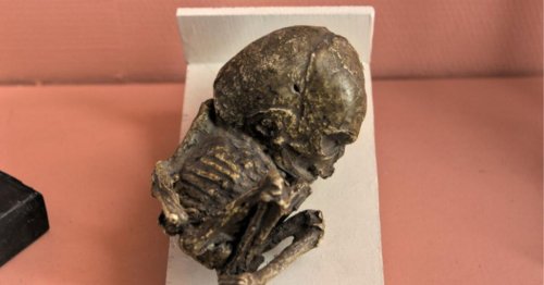 Lithopédion : elle décède à cause d’un fœtus calcifié qu’elle portait depuis neuf ans