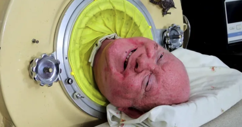 Paul Alexander, 78-year-old Dallas man who lived in an iron lung for most of his life, dies