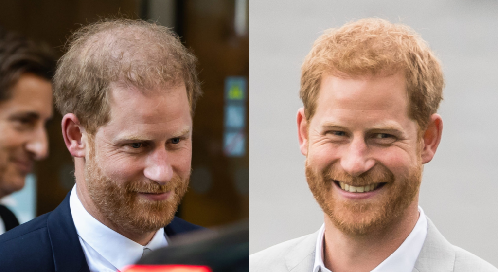 Prince Harry losing his hair could be from 'tension with William and Charles'