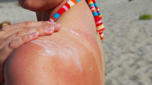 Sonnenbrand: Diese 5 Fehler sollten Sie unbedingt vermeiden