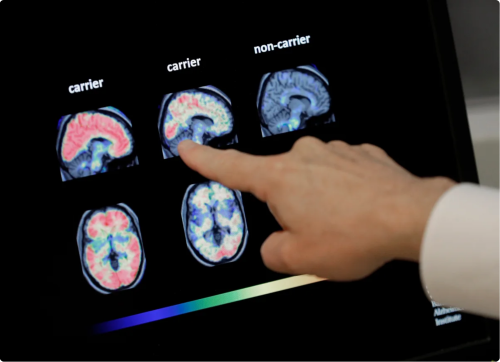 Neuer Bluttest: Kann man damit Alzheimer früher erkennen?