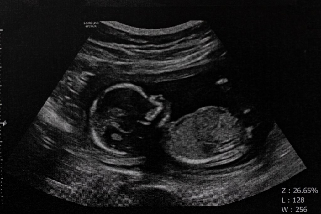 Abortion - cover