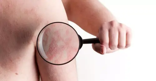 DWP list of skin conditions that could get you over £600 a month - check if you are eligible
