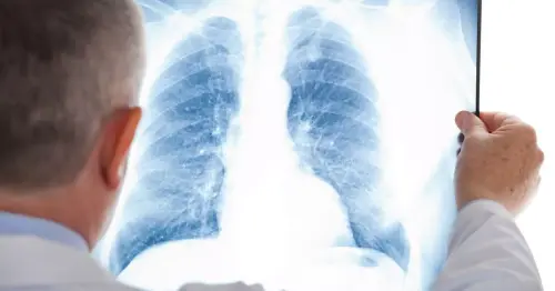 Less common symptoms of lung cancer to watch out for - including changes to your fingers