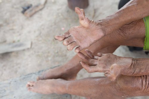 Leprosy: Biblical disease still around, and its symptoms can take up to 20 years to appear | The Citizen
