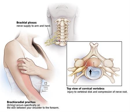 Brachioradial Pruritus: Symptoms, Causes, Treatment & Recovery