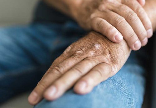 Ways To Prevent Psoriatic Arthritis Flare-ups