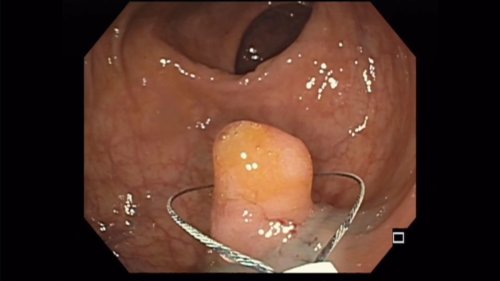 Endoscopic Mucosal Resection Case by Dr Neil Sharma, of Parkview Health Fort Wayne, IN - BroadcastMed