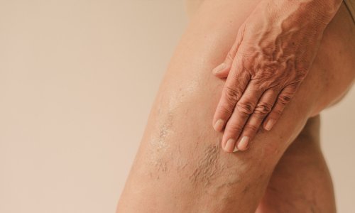 Crepey Skin On The Legs: Causes, Treatments & More