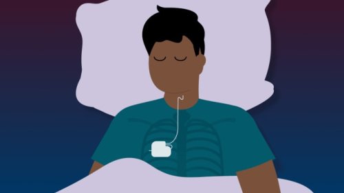No More CPAP? What to Know About Inspire Sleep Apnea Treatment