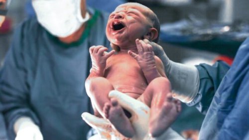 No link found between caesarean birth and food allergies