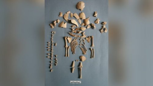 Down syndrome cases in Bronze and Iron Ages