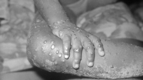 Unexpected monkeypox outbreak cause for concern, but not conspiracy theories, experts say