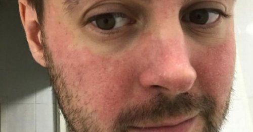 Man who suffered from 'red and blotchy skin for years' discovers why during lockdown