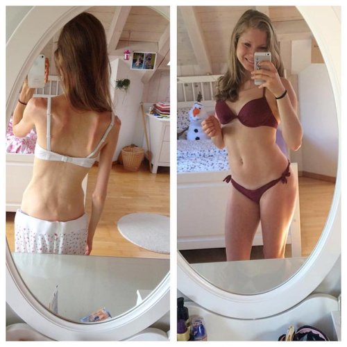 Woman fires back at bullies with inspiring eating-disorder recovery photos