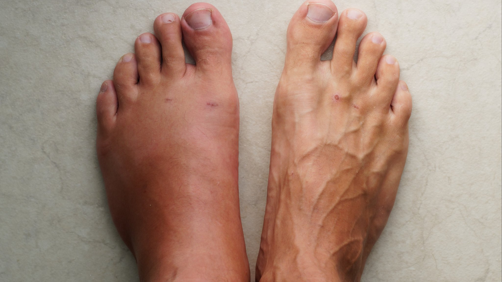 Swollen Feet: 8 Medical Conditions That Can Make Feet Puff Up
