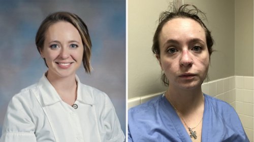 'It's exhausting': ICU nurse shares before-and-after photos of herself to show pandemic toll