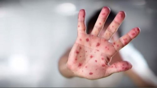 Another measles case confirmed in Ont. child who recently returned from Europe
