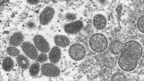 New cases of mpox diagnosed in Montreal: public health