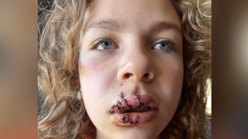 'It was just really fast': Dog bite leaves Claresholm, Alta. girl with 16 stitches in her face
