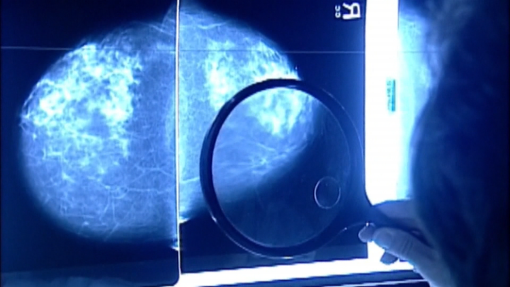 Months of waiting for breast biopsies "unacceptable," says BC doctor