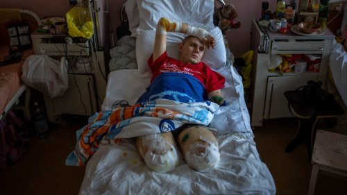 War wounds: Limbs lost and lives devastated in an instant in Ukraine