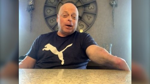 Man hoping for first double hand transplant in Canada faces COVID-19 setbacks