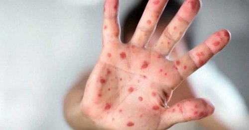 Measles case confirmed in Calgary area; potential exposures in Airdrie, Balzac