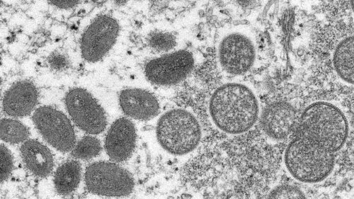 Ontario monkeypox cases triple in two weeks, surpass 100