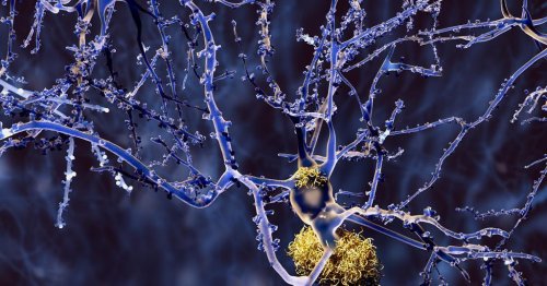 Biochemical mystery unfolds as elemental metals found in Alzheimer’s patients’ brains